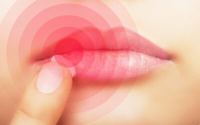 Treating Cold Sores
