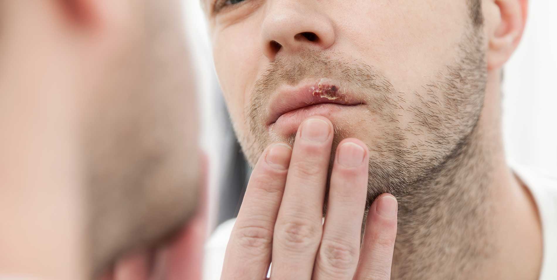 cold-sore-outbreaks cold-sore-outbreaks